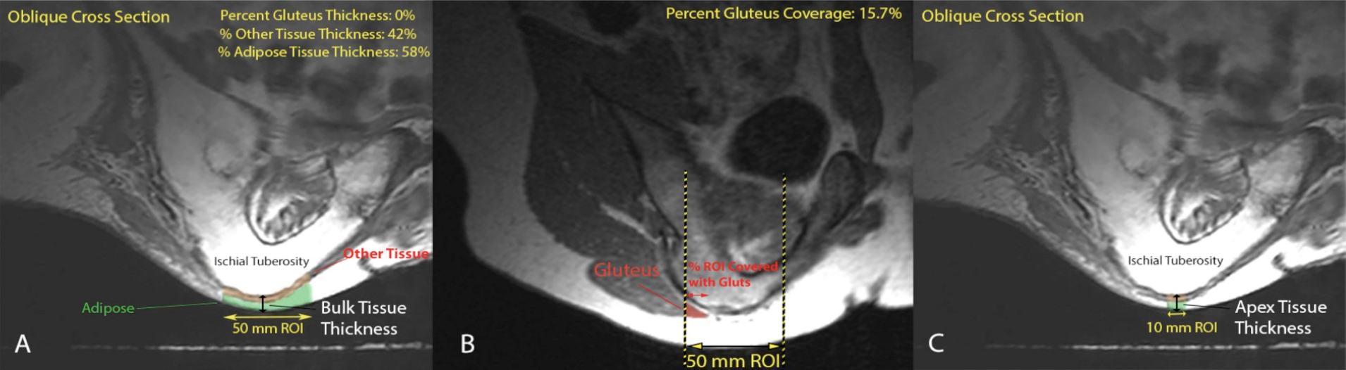 MRI findings from 'Seated buttocks anatomy and its impact on biomechanical risk' by Sonenblum et al.